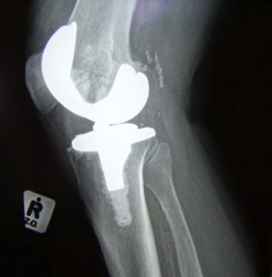knee-replacement-xray-sxc
